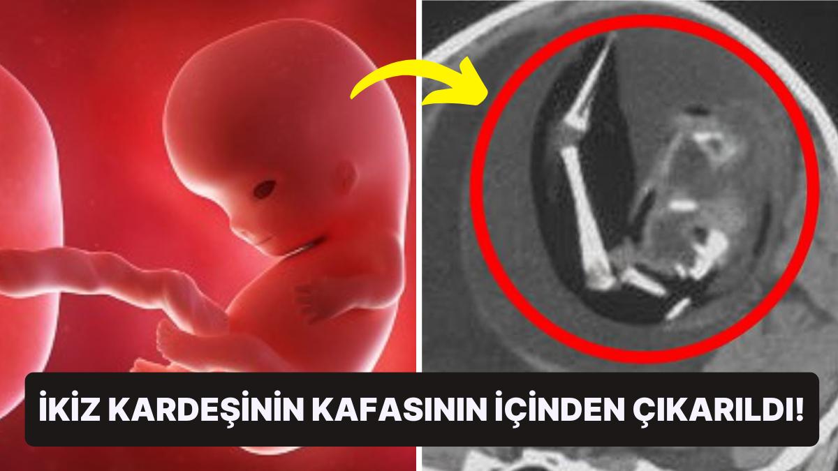 Akıllara Sakinlik Veren Ameliyat: Çin'de 1 Yaşındaki Kızın Kafatasından Doğmamış İkiz Kardeşi Çıkarıldı!