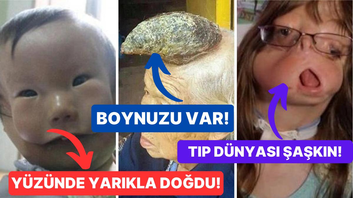 Daha Evvel Hiçbir Yerde Duymadığınızı Sav Ettiğimiz Tıp Dünyasını Bile Şaşkına Çeviren 15 Hastalık