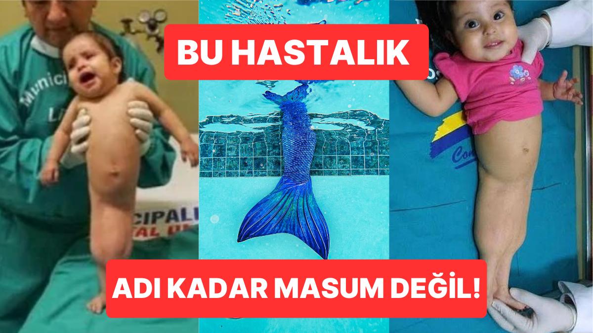 Olaylar 24 Saat İçerisinde Hayatını Kaybediyor! Dünyanın En Ender Görülen Sendromu: Sirenomeli Deniz Kızı