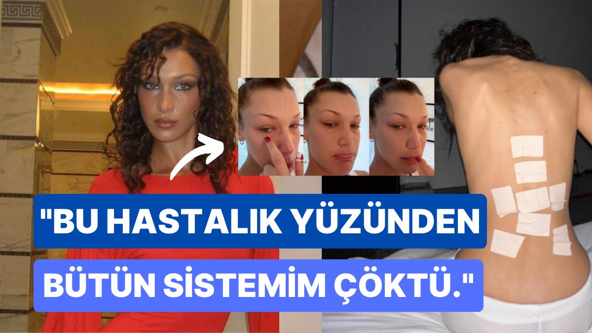 Bella Hadid, Hastalığı Hakkında Birinci Kere Konuştu: "Her Gün Tedavisi Olmayan Acılar Çekiyorum!"