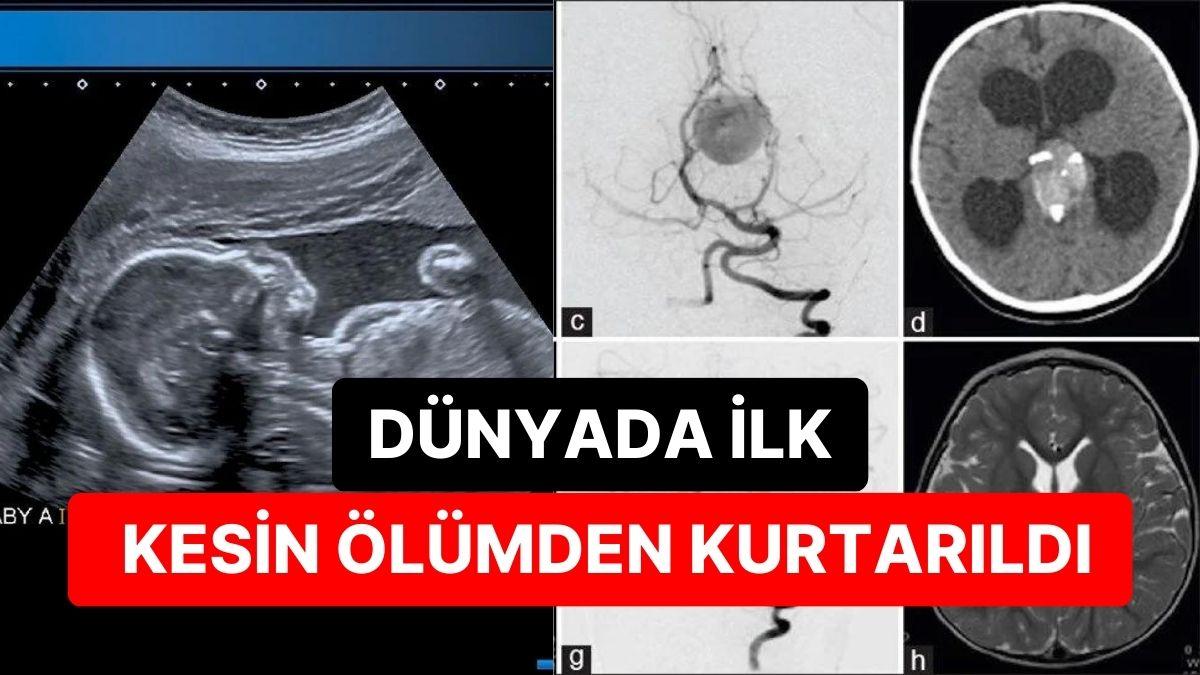 Dünyada Birinci: Anne Karnındaki Bebeğe Beyin Ameliyatı Yapıldı