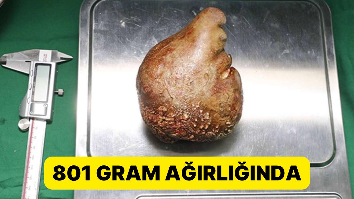 62 Yaşındaki Hastanın Böbreğinden 801 Gram Tartısında Taş Çıkarıldı