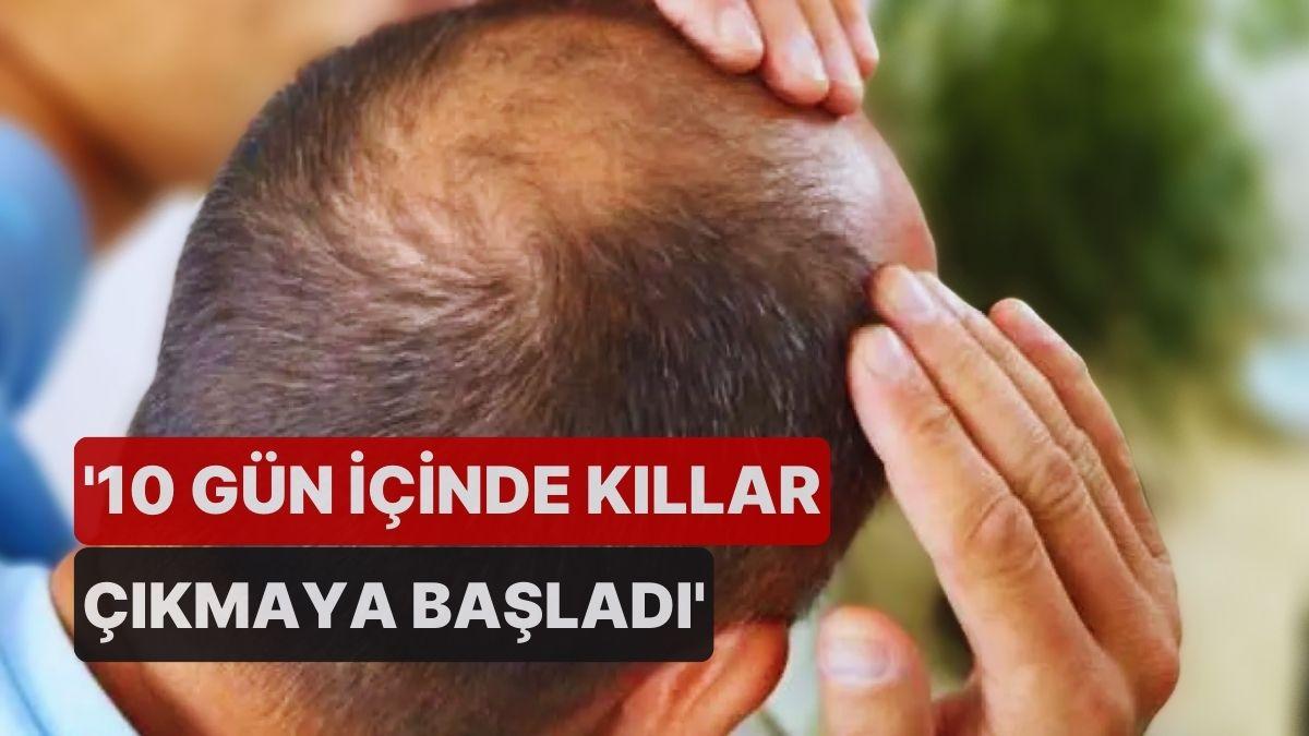 Genetik Bilimciler Açıkladı: Kelliğin Dermanı Bulundu!